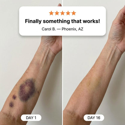 😆Surprise！💕 Most Customers Grab Two — Get Your 2nd CureVivo® 70% OFF